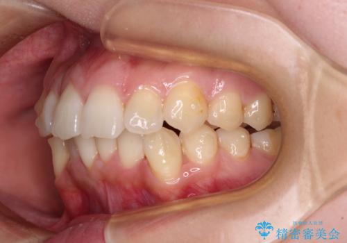 【モニター】前歯のデコボコをインビザラインで改善の治療中