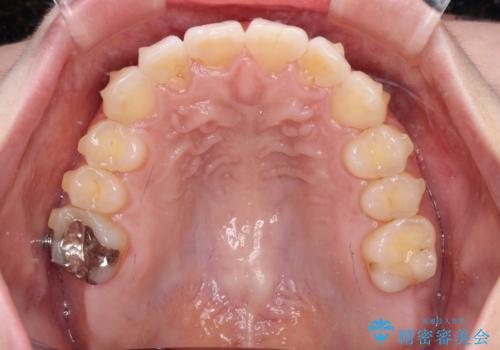 【モニター】前歯のデコボコをインビザラインで改善の治療中