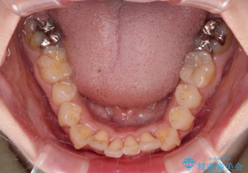 【モニター】前歯のデコボコをインビザラインで改善の治療中