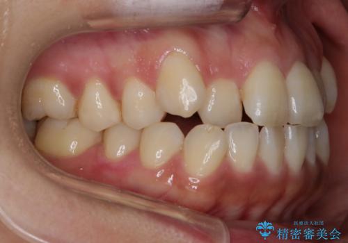 【非抜歯】20代女性　歯のガタつきと噛み合わせの治療の治療前