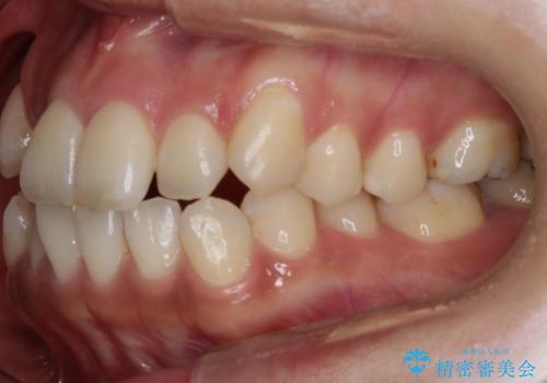 【非抜歯】20代女性 歯のガタつきと噛み合わせの治療の治療前