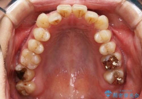 【非抜歯】20代女性 歯のガタつきと噛み合わせの治療の治療前