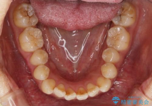 【非抜歯】20代女性 歯のガタつきと噛み合わせの治療の治療前