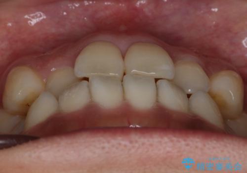 【非抜歯】20代女性　歯のガタつきと噛み合わせの治療の治療前