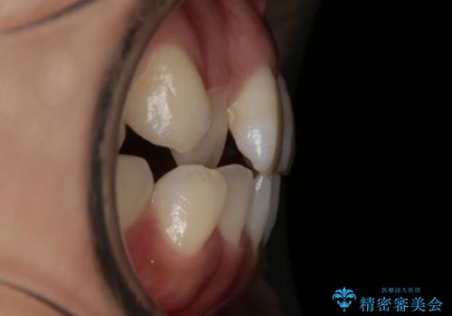 【非抜歯】20代女性 歯のガタつきと噛み合わせの治療の治療前