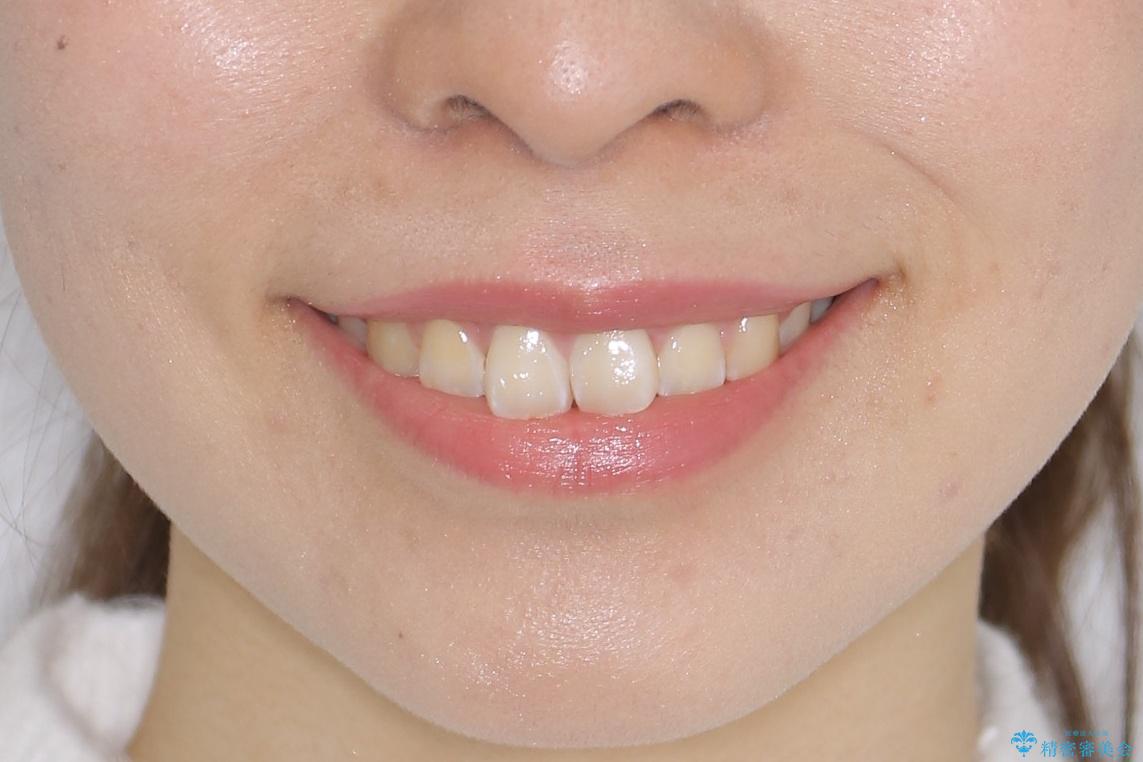 【非抜歯】ガタつきと歯軸を正して長持ちする歯への治療前（顔貌）
