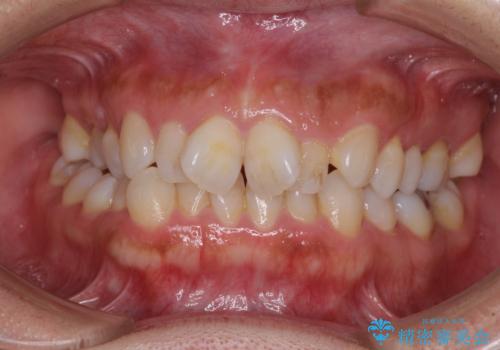既に2本が抜歯されている歯列　咬み合わせのズレを改善する抜歯矯正の症例 治療前