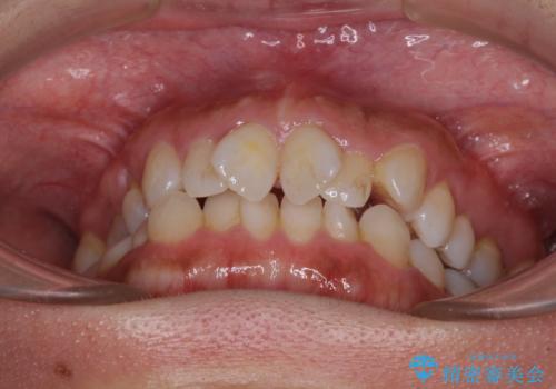 既に2本が抜歯されている歯列　咬み合わせのズレを改善する抜歯矯正の治療前