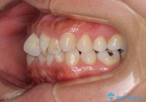 既に2本が抜歯されている歯列 咬み合わせのズレを改善する抜歯矯正の治療前