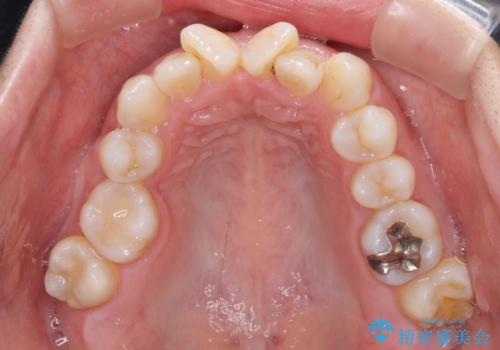 既に2本が抜歯されている歯列 咬み合わせのズレを改善する抜歯矯正の治療前