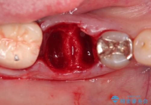 【インプラント】食事中に歯が割れた! かなり深いところまで歯が割れていたの治療中