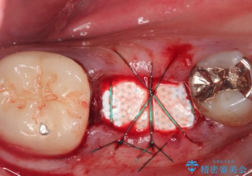【インプラント】食事中に歯が割れた! かなり深いところまで歯が割れていたの治療中