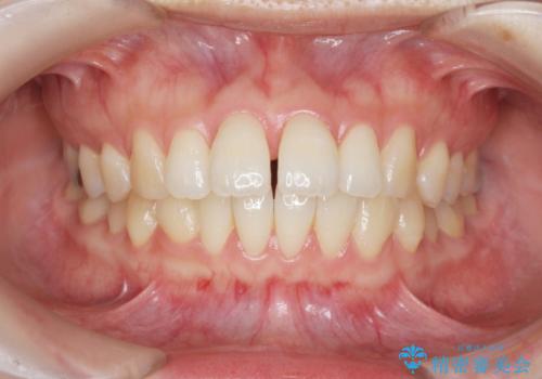 マウスピースで治す、出っ歯の矯正治療の治療前