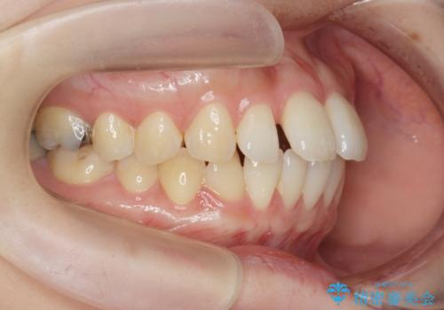 マウスピースで治す、出っ歯の矯正治療の症例 治療前