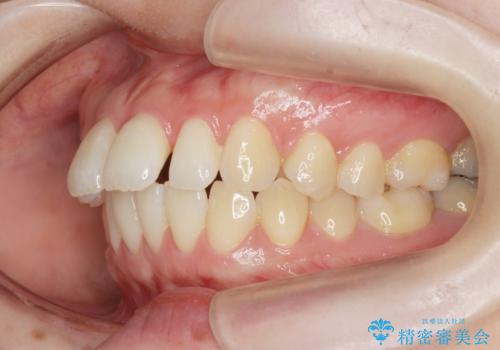 マウスピースで治す、出っ歯の矯正治療の治療前