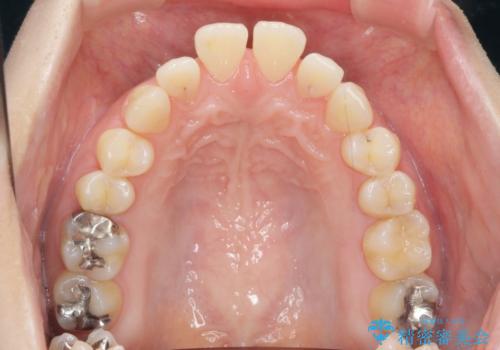 マウスピースで治す、出っ歯の矯正治療の治療前