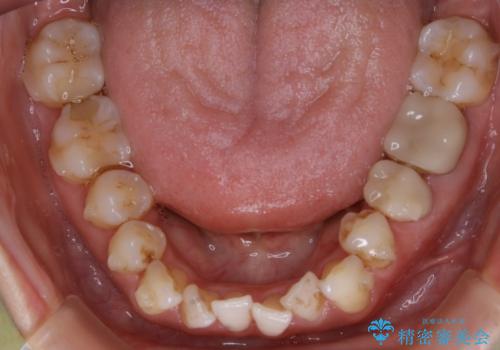 【非抜歯】歯を抜かなくても短期間でキレイな歯並びにの治療中