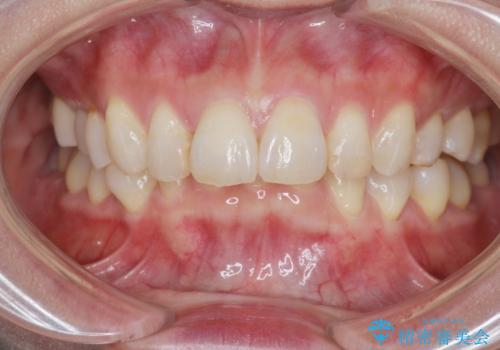 インビザラインで行う前歯のみの部分矯正の治療後