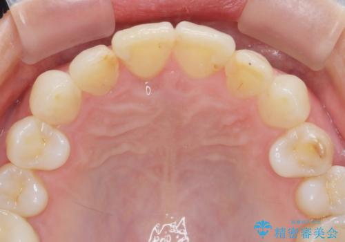 インビザラインで行う前歯のみの部分矯正の症例 治療後