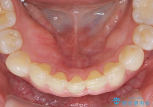 インビザラインで行う前歯のみの部分矯正の治療後