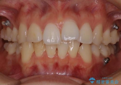 【再矯正】後戻りによるガタつきをマウスピースで改善!の治療中