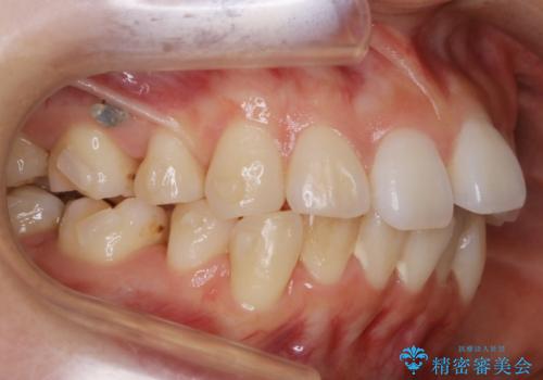 【再矯正】後戻りによるガタつきをマウスピースで改善!の治療中