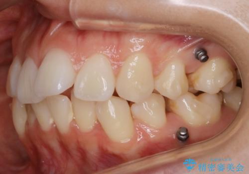 【再矯正】後戻りによるガタつきをマウスピースで改善!の治療中