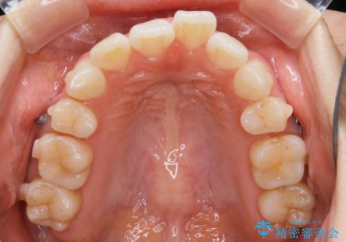 【再矯正】後戻りによるガタつきをマウスピースで改善!の治療中