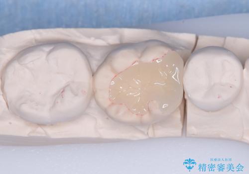 【ハイブリッドインレー】銀歯を白くしたい!の治療中