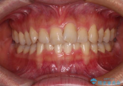 手間をかけずに治したい 短期間のワイヤー矯正の症例 治療前