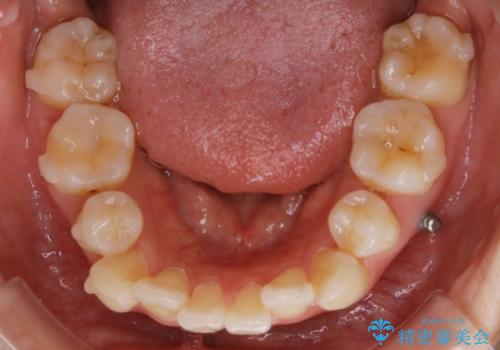 【再矯正】後戻りによるガタつきをマウスピースで改善!の治療中