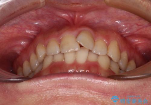 手間をかけずに治したい 短期間のワイヤー矯正の治療前