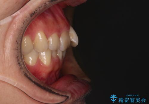 手間をかけずに治したい 短期間のワイヤー矯正の治療前