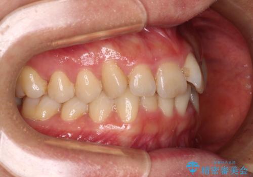 手間をかけずに治したい 短期間のワイヤー矯正の治療前