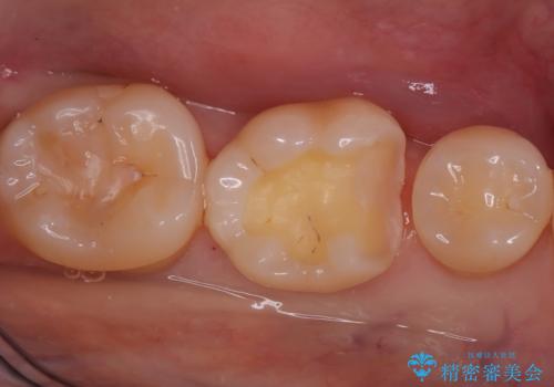 【ハイブリッドインレー】銀歯を白くしたい!の治療中