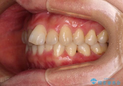 手間をかけずに治したい 短期間のワイヤー矯正の治療前