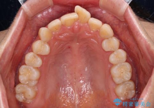 手間をかけずに治したい 短期間のワイヤー矯正の治療前