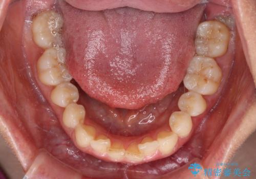 手間をかけずに治したい 短期間のワイヤー矯正の治療前