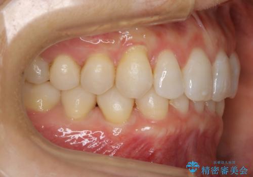 【抜歯】矯正治療とインプラントで正常な噛み合わせを実現の治療後