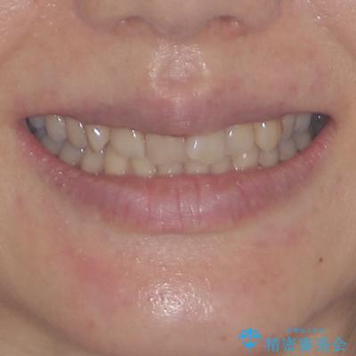 手間をかけずに治したい 短期間のワイヤー矯正の治療前(顔貌)