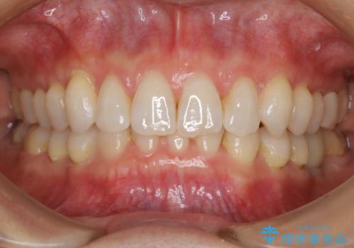 【抜歯】矯正治療とインプラントで正常な噛み合わせを実現の症例 治療後