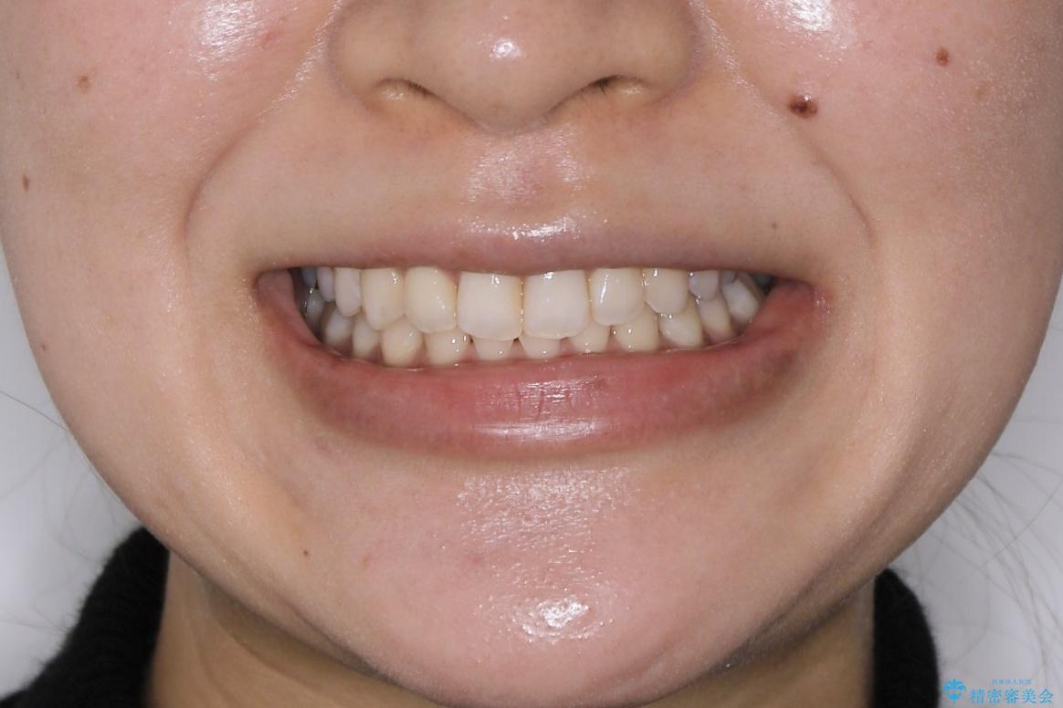 【非抜歯】下の前歯が1本少ない場合の矯正治療の治療後（顔貌）