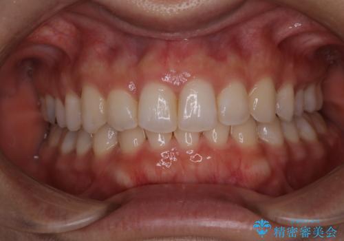 【非抜歯】下の前歯が1本少ない場合の矯正治療の症例 治療後