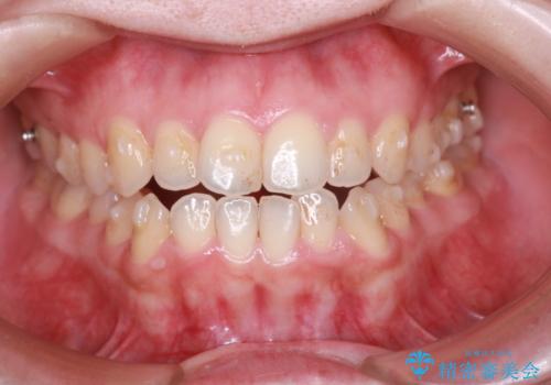 【オープンバイト】前歯のがたがたをなおしたい。の治療中