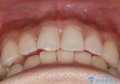 【非抜歯】下の前歯が1本少ない場合の矯正治療の治療後