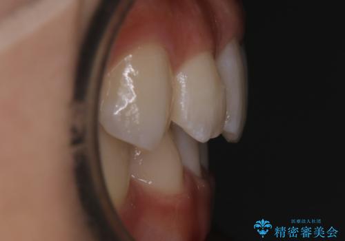 【非抜歯】下の前歯が1本少ない場合の矯正治療の治療後