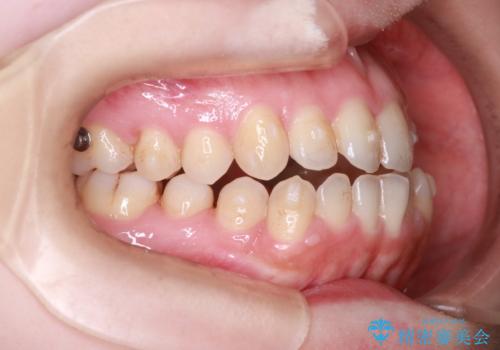 【オープンバイト】前歯のがたがたをなおしたい。の治療中