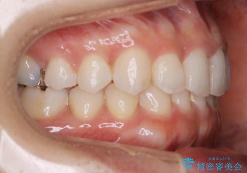【非抜歯】下の前歯が1本少ない場合の矯正治療の治療後