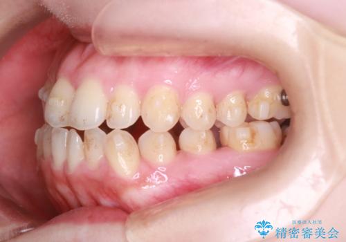 【オープンバイト】前歯のがたがたをなおしたい。の治療中