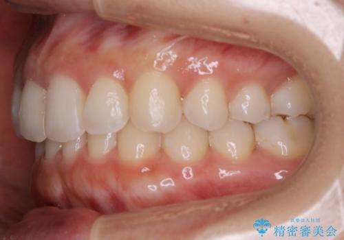 【非抜歯】下の前歯が1本少ない場合の矯正治療の治療後